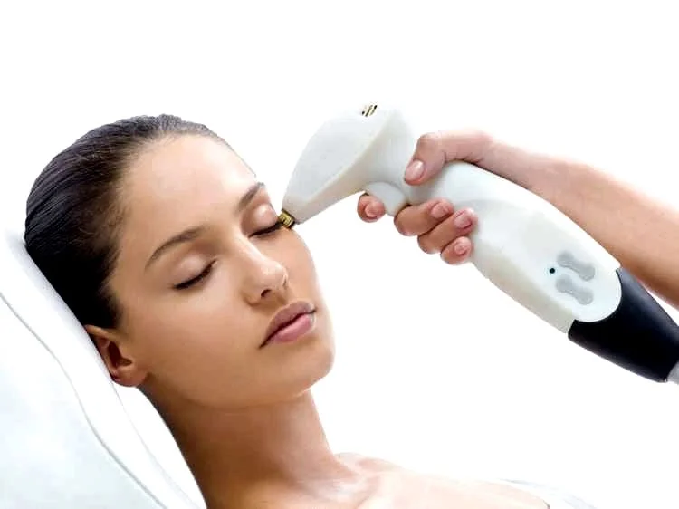 Face Skin Tightening with Radiofrequency