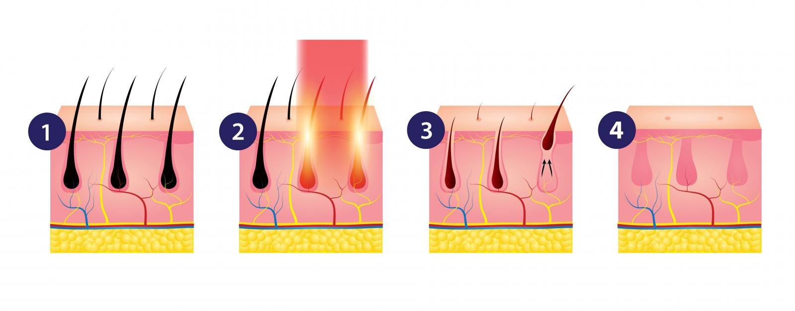 Hair Removal Cheltenham