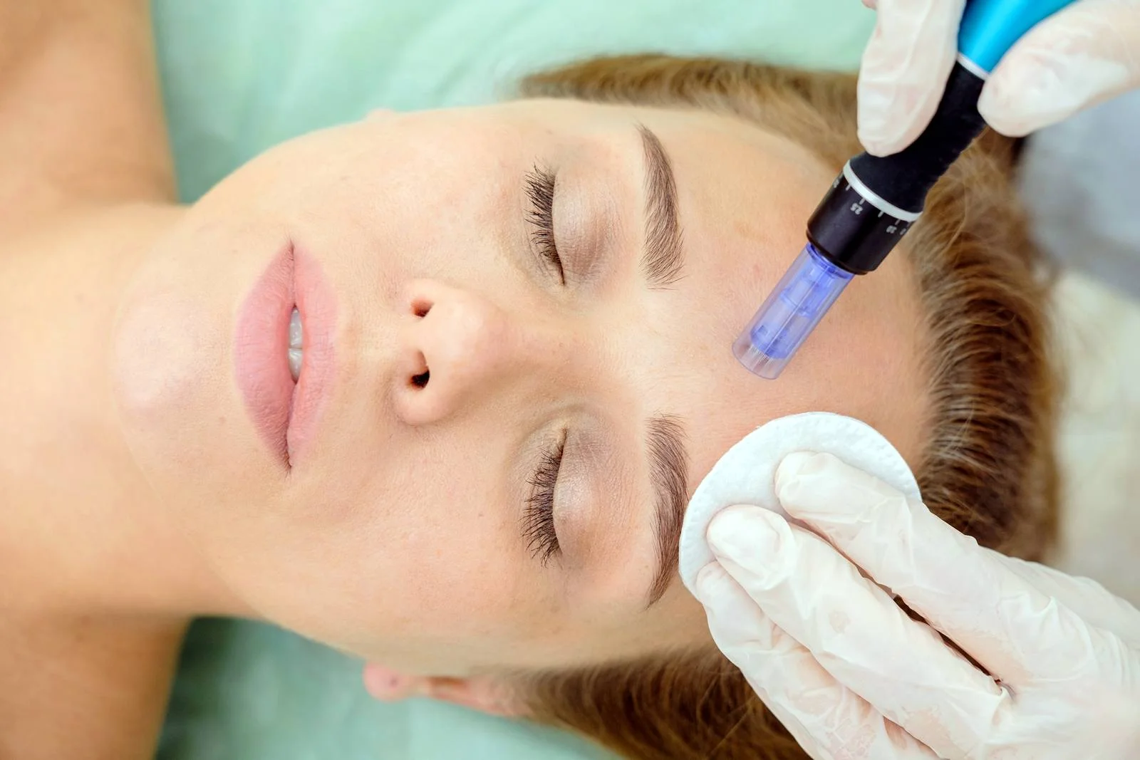 Microneedling Cheltenham