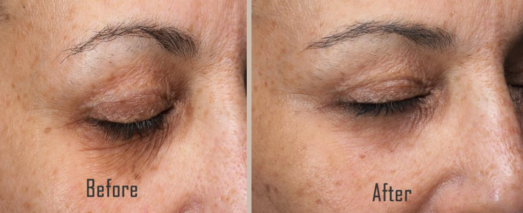 Tixel Eyes Before and After