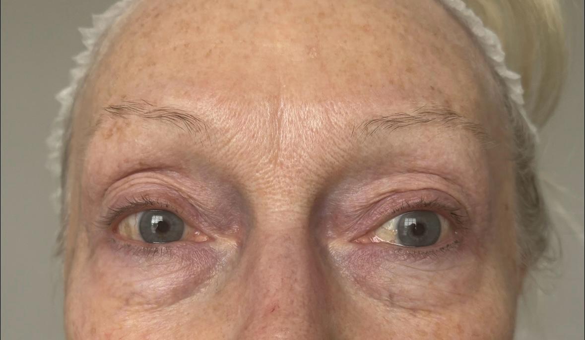 Before Eye Bags