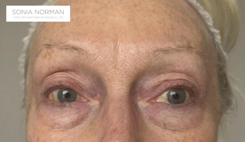 Before Tixel Eyes