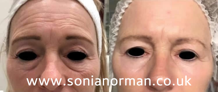 Before and After Tixel Eyes