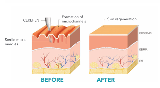 Cerepen Before and After