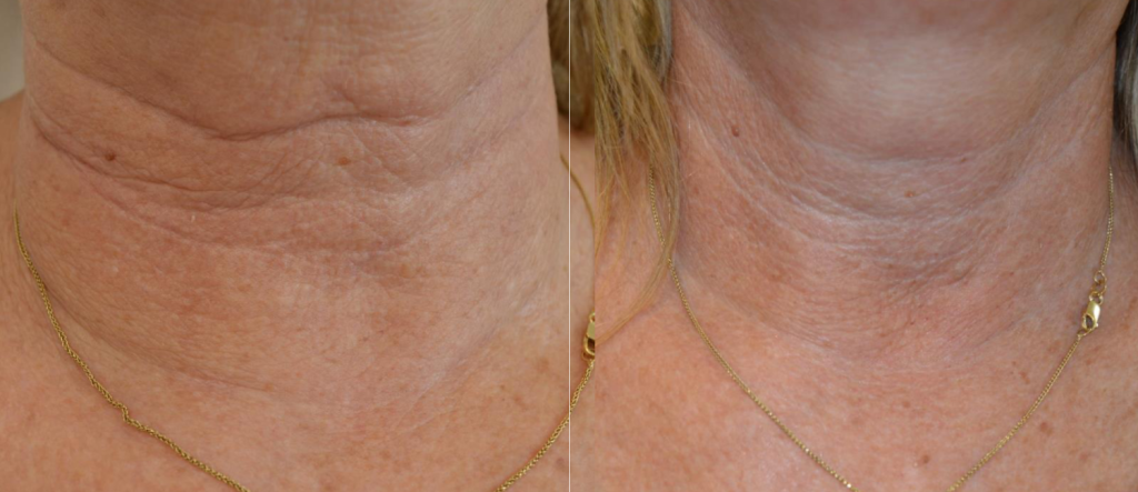Neck Before and after