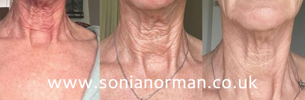 Tixel Neck Before and After