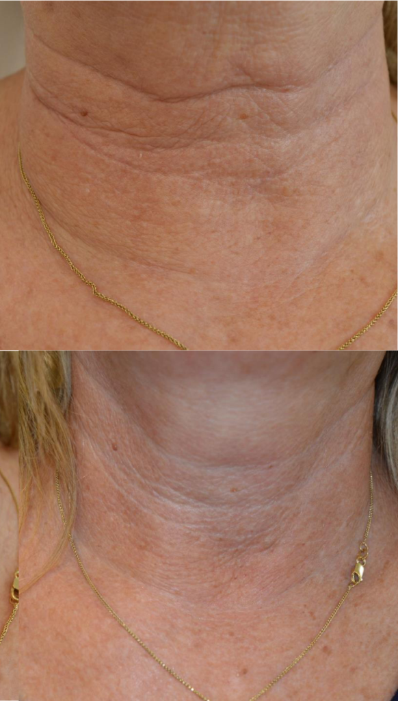 Neck before and after