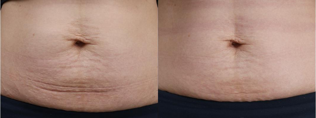 stretch-marks