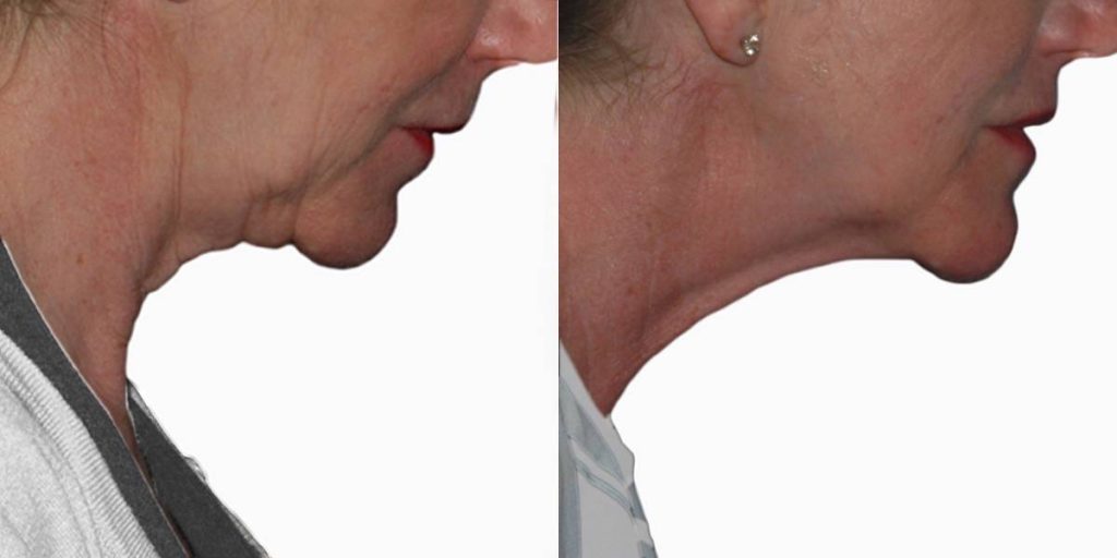 Chin before and after result