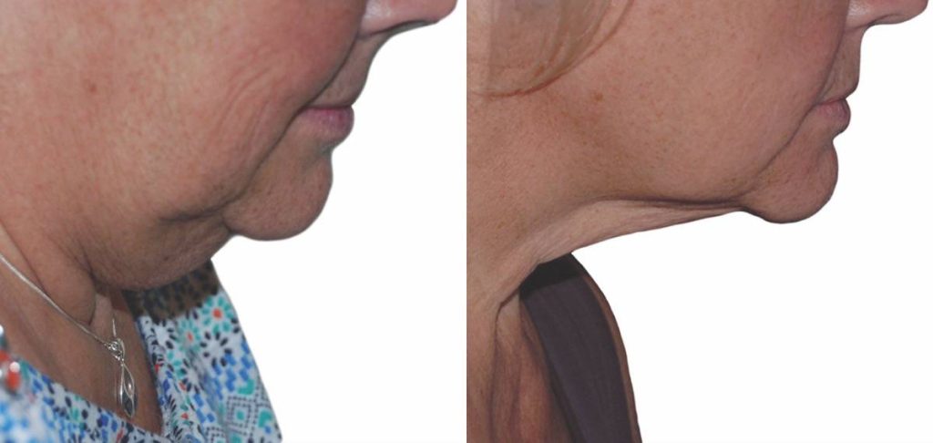 Chin and jawline treatment result