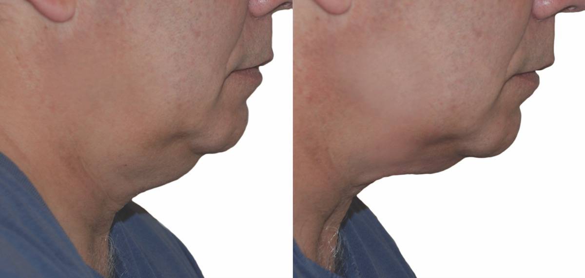 Chin