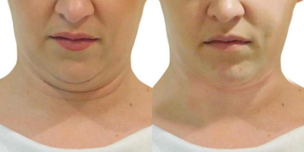 Double chin HIFU treatment result