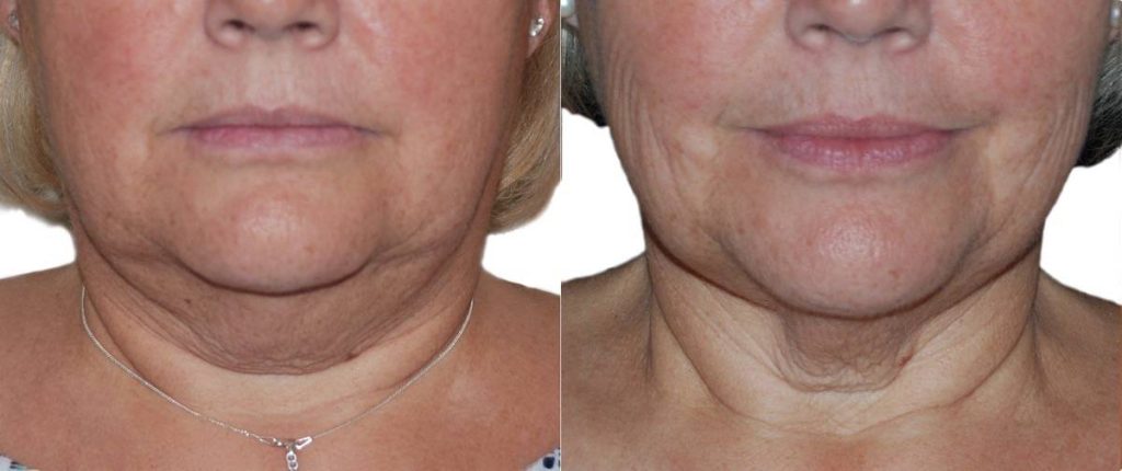 Laser Face Treatment