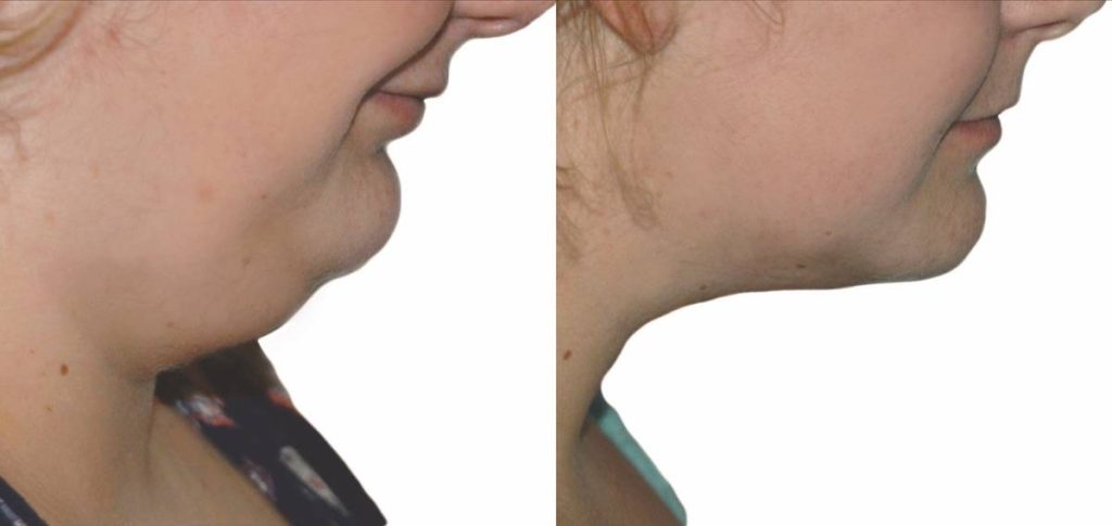 Laser lipo and HIFU before and after