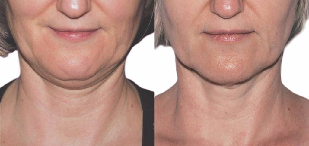 Strawberry Lift HIFU before and after