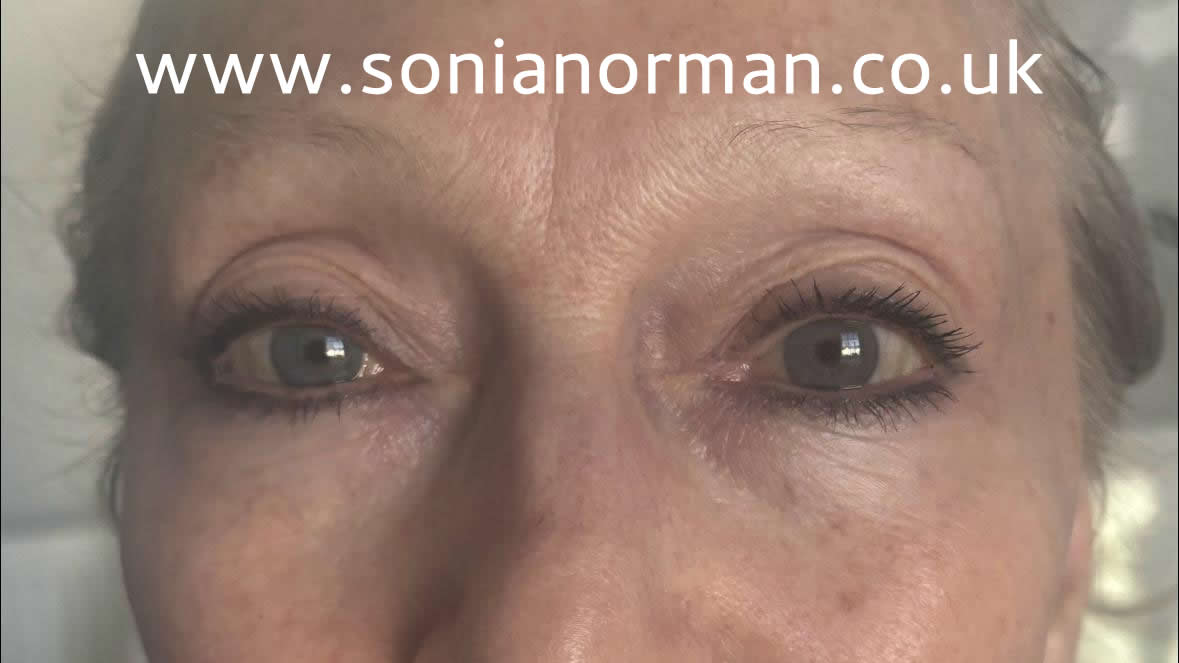 After-3-Treatments-Eye-Bags