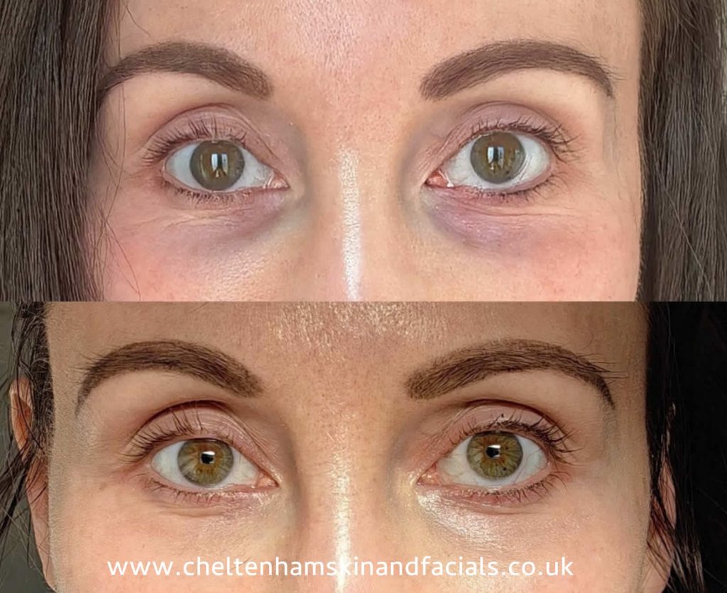 Dark Circles Tixel