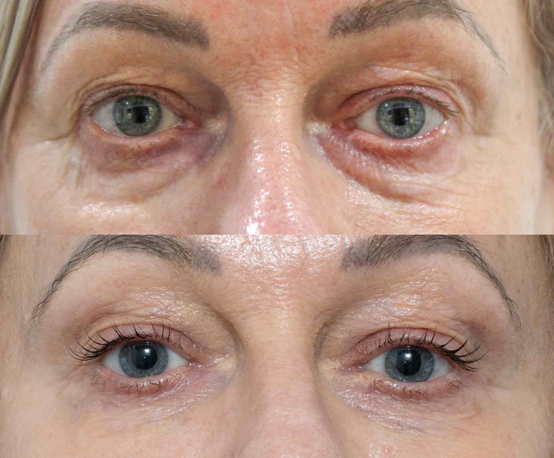 Eye Rejuvenation