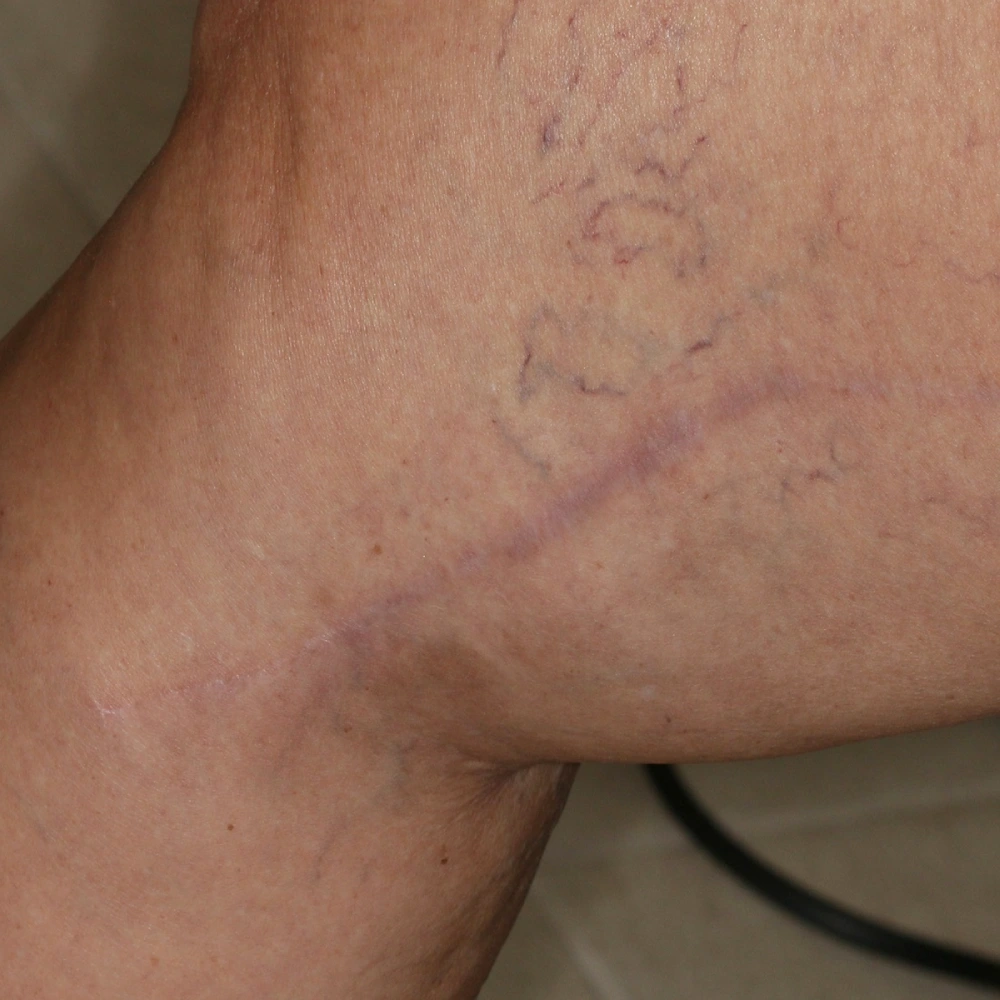 Scar after Tixel treatment