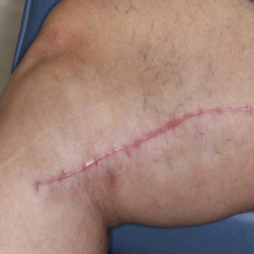 Scar Before Tixel