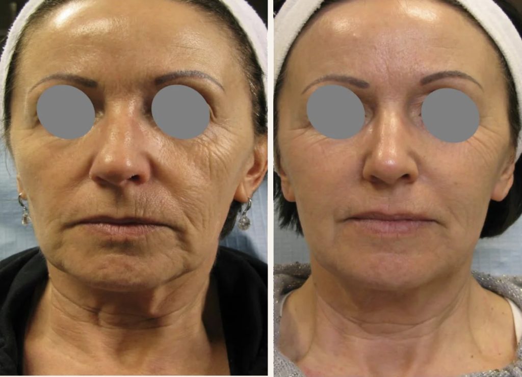 Tixel rejuvenation before and after