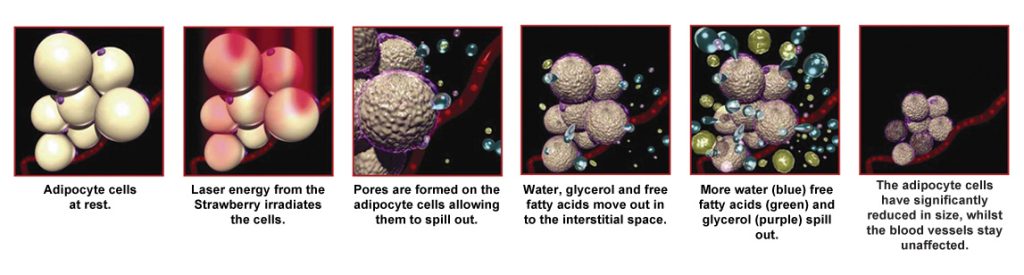 Fat cells during Laser Lipo treatment
