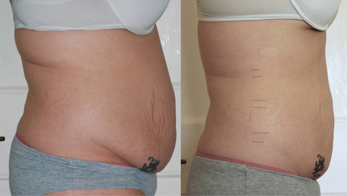 Inch Loss Belly