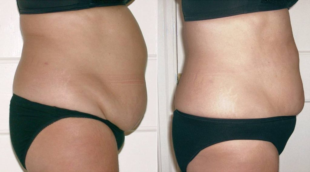 Inch Loss Tummy