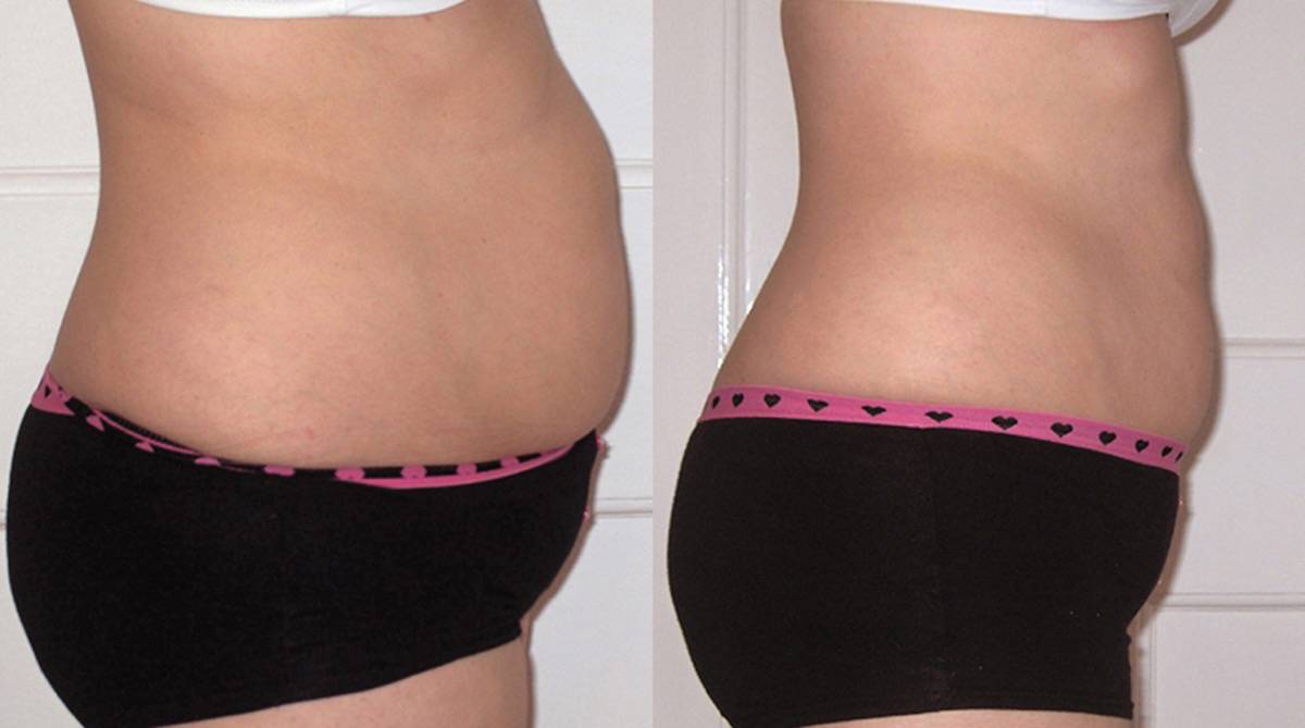 Fat Reduction Abdomen