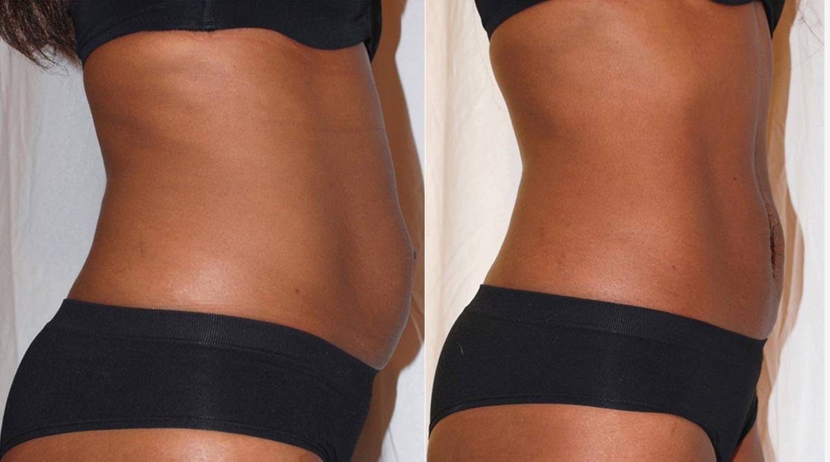 Body Fat Loss
